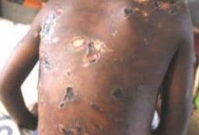 A seven-year-old boy, Benedicto Albert was beaten by his father, a policeman, Albert Benedicto in Simiyu Region, Tanzania